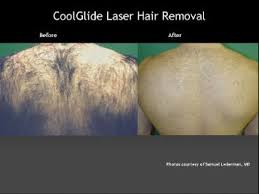 Laser-Hair-Removal-02