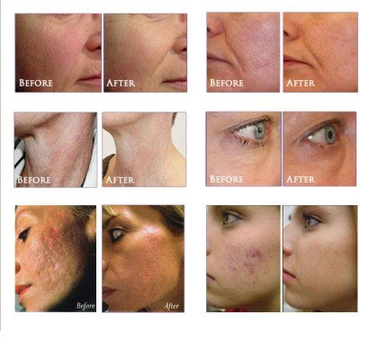 Laser Genesis Skin Therapy